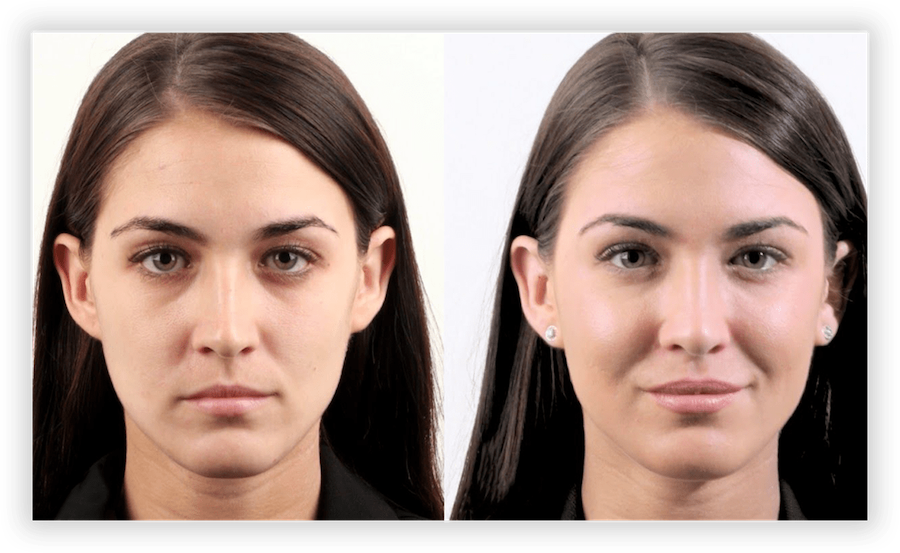 Non Surgical Facelift 1